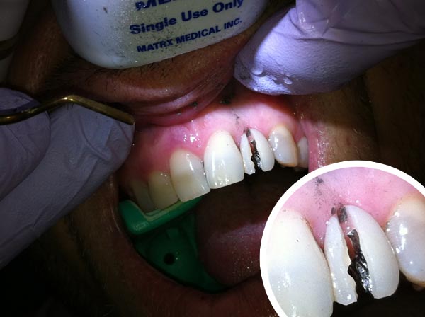 Bye-bye natural gum line | Go Dental | Valencia CA 