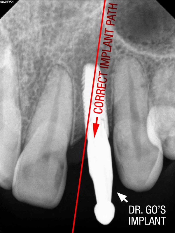 Botched Implant Placement | Go Dental