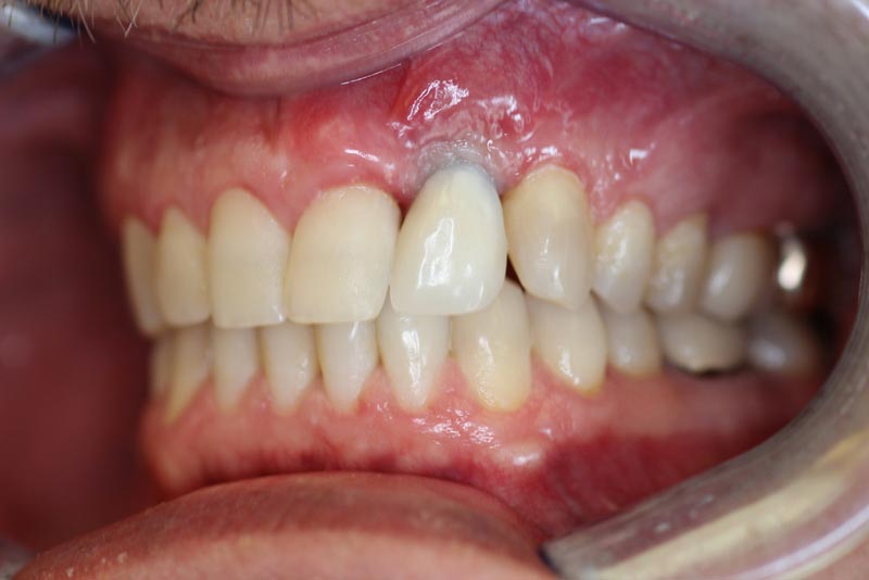 Temporary tooth after VISTA gum graft surgery | Dr. Homa Zadeh 